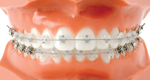 keramik-brackets Titel Zahnspange frontal